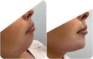 chin augmentation before and after
