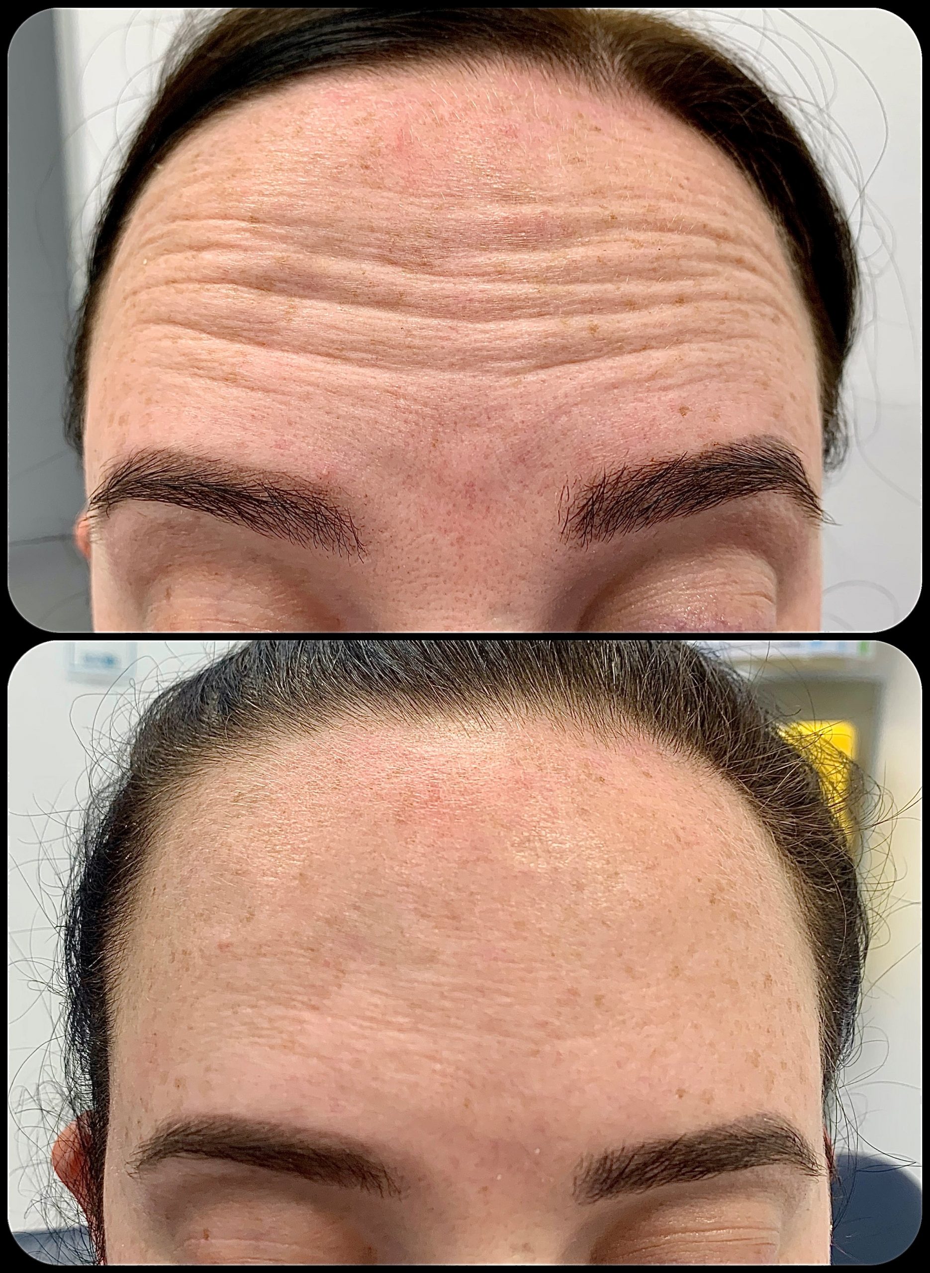 Forehead Lines - Health Hub Doctors Morayfield